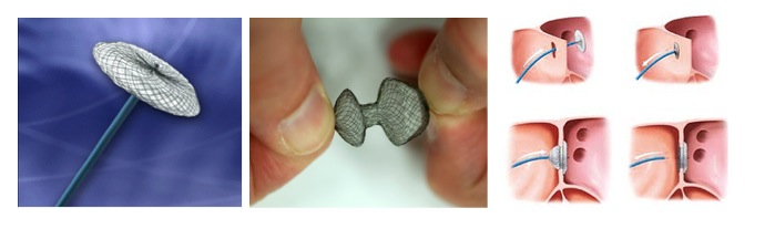 dispositivos intracardiacos