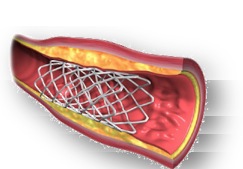 stent 3